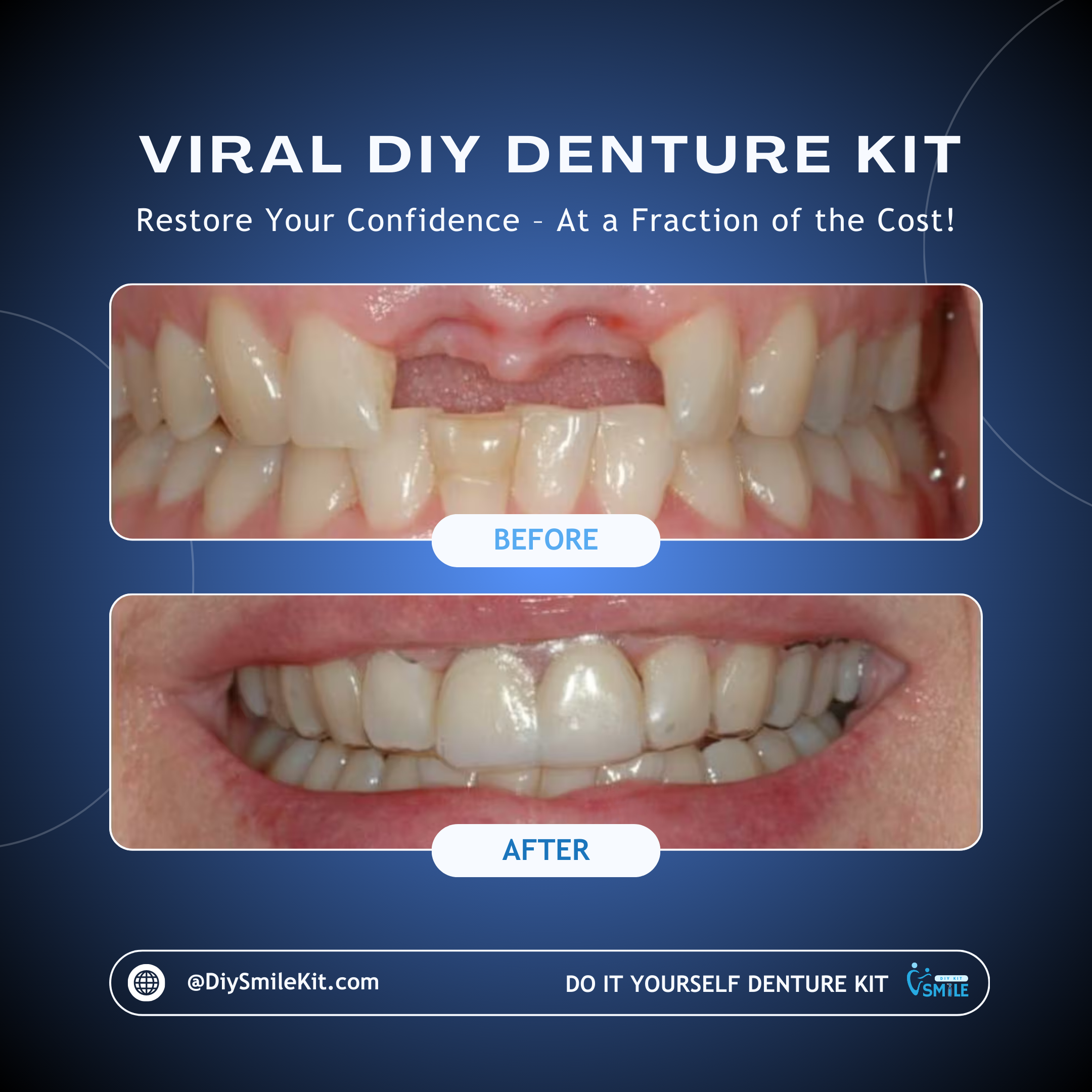 DIY Denture Kit (Partial Denture)