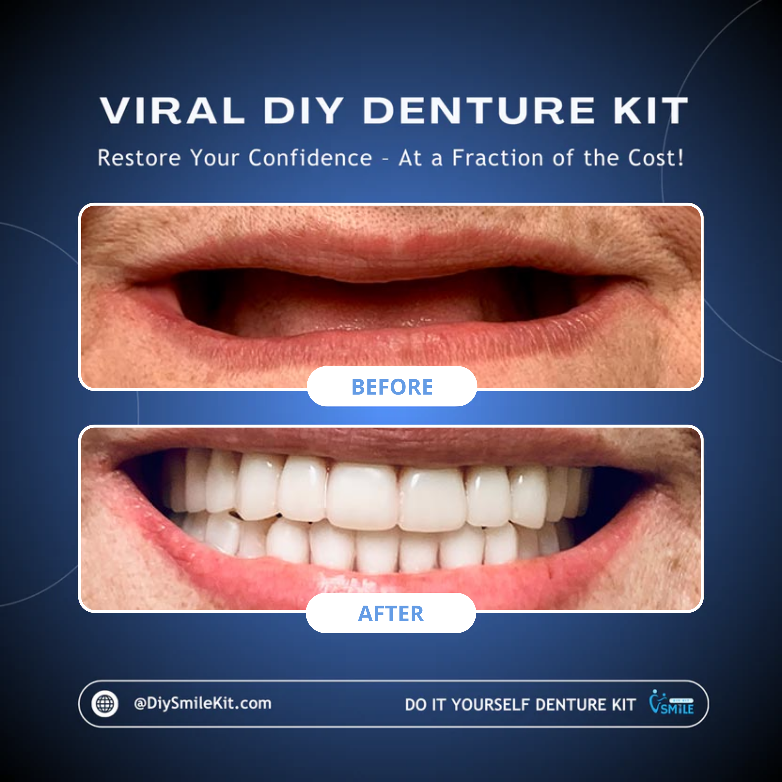 DIY Denture Kit (Upper + Lower - FULL Denture)